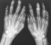 手指关节炎有哪些症状表现