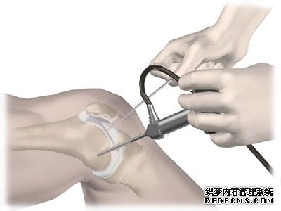 治疗骨性关节炎要积极