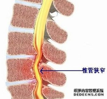 颈椎管狭窄哪儿治得好？