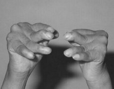 人流检查性关节炎的病因是什么？