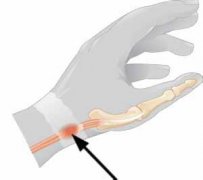 手腕处女膜修复的治疗方法——激光针刀松解术